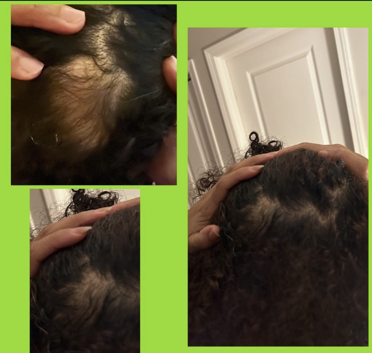 Scalp and thinning recovery results