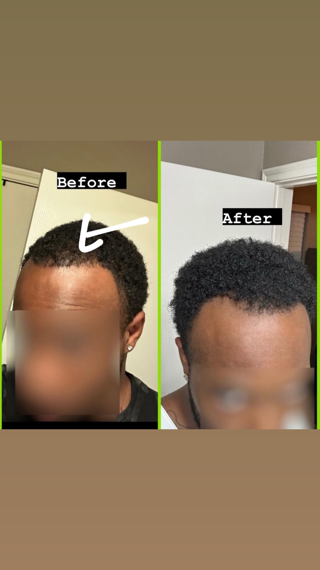 Men's hairline restored with kawnaturals