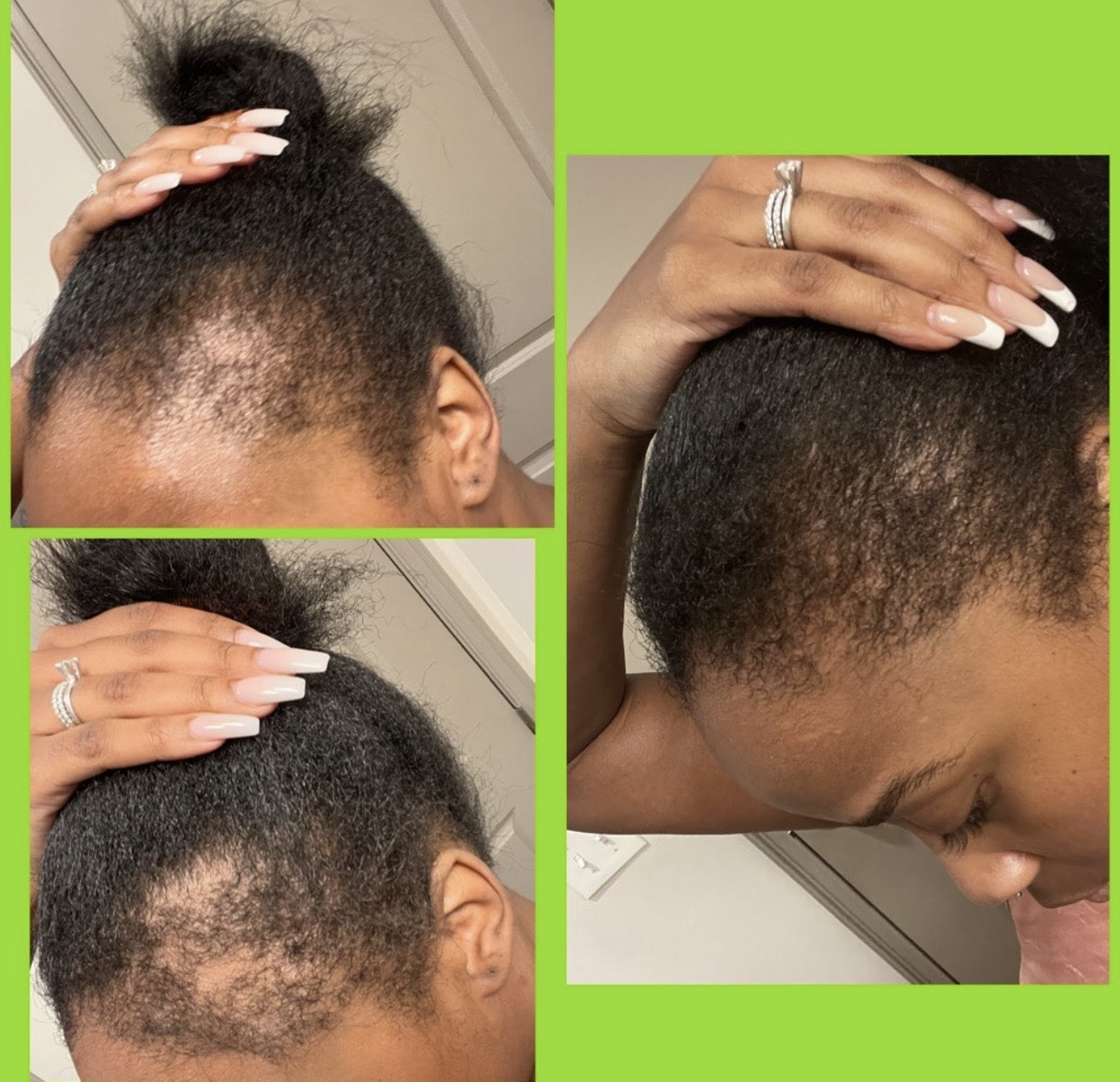 Edges and thinning hair recovery